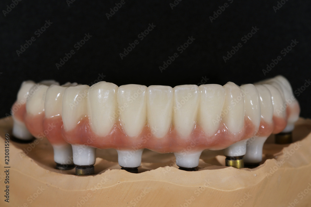 high-quality prosthesis with artificial gingiva and twist 6 multiyunitah high-quality prosthesis with artificial gingiva and twist 6 multiyunitah