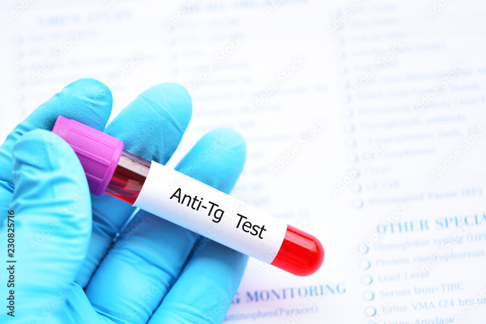 Blood sample tube for antiTg or antithyroglobulin test, diagnosis for