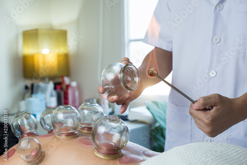 a lot of glass cup on the back of a man,Traditional Chinese Medicine Treatment - Acupuncture