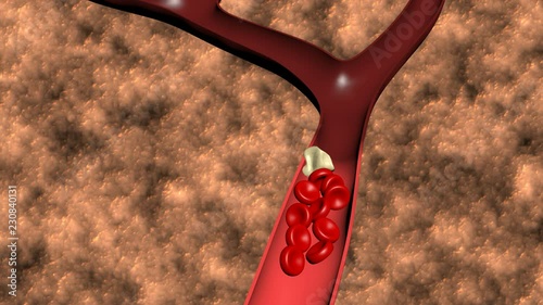 Animation of the formation of thrombosis photo