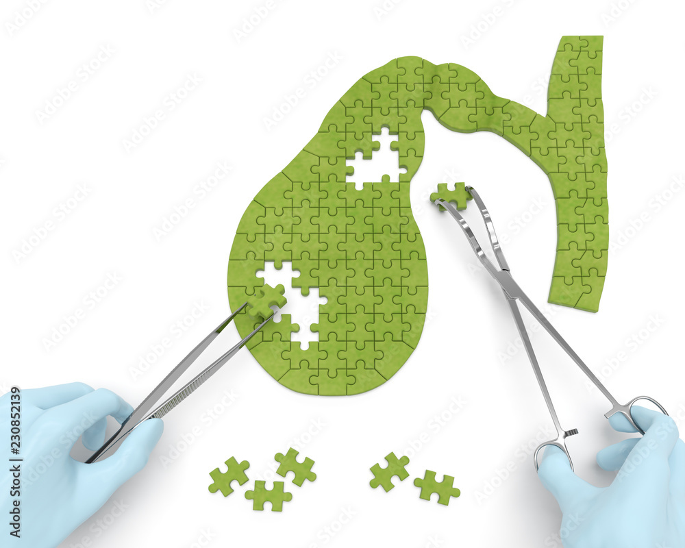 Gallbladder puzzle concept: hands of surgeon with surgical instruments ...