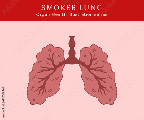 Sick Smoker lung illustration