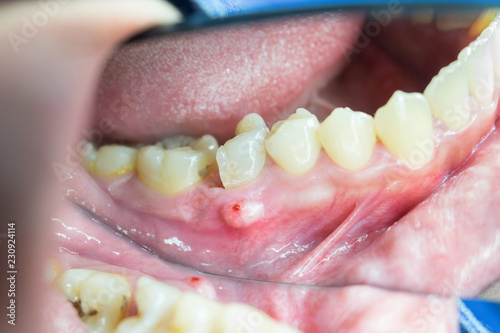 dental root abscess from decayed tooth