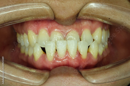 underbite malocclusion