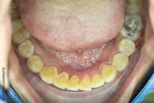 tartar on lower teeth
