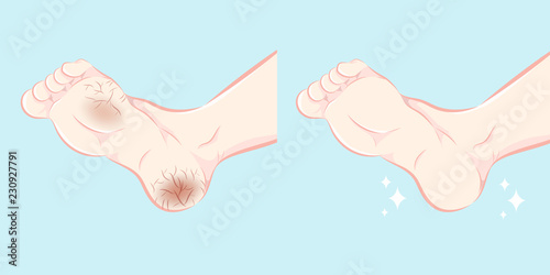 Feet with dry skin