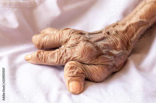 The hands of an old woman with rheumatoid arthritis. Diseases caused by degeneration of the joints of the fingers. © witsawat