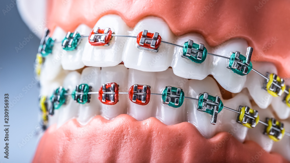 Close-up of a orthodontic model jaws and teeth with braces Stock Photo ...