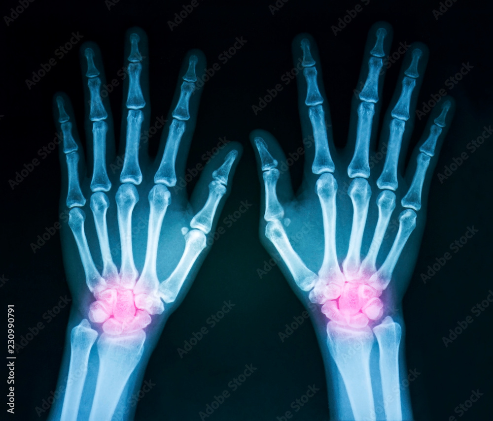 Film x-ray both human's hands and wrist arthritis, marking in red color Film x-ray both human's hands and wrist arthritis, marking in red color