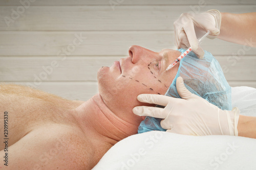 The man on the face is marked with guides before surgery filling wrinkles, crow's feet, injection of hyaluronic acid, plastic operation