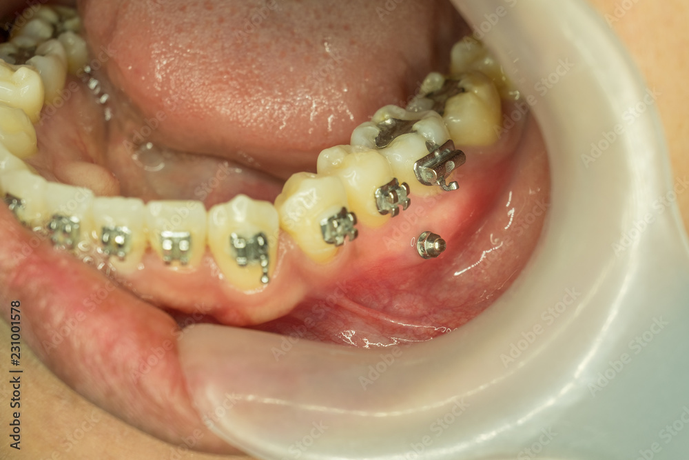 miniscrew in orthodontic treatment