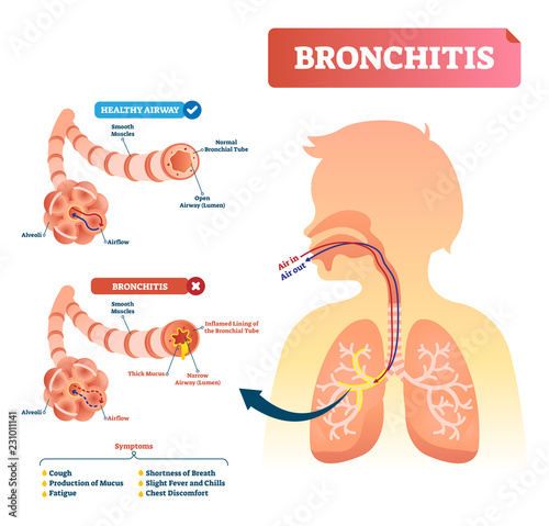Bronchitis vector illustration. Lung disease diagnosis with symptoms.