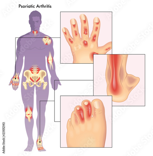Illustration of human body showing close up of anatomy effected by psoriatic arthritis. photo