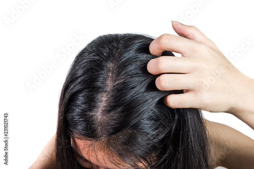 women head with dandruff Caused by the problem of dirty. Or caused by skin disease or Seborrheic Dermatitis. It has white scaly and it will cause itch. Product Concepts Scalp Care and Hair Care.
