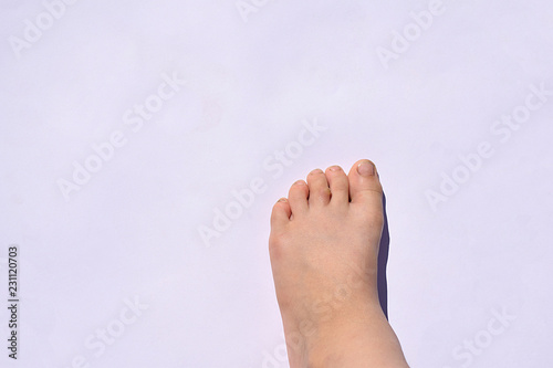 The usual flat wart on the child's toe.