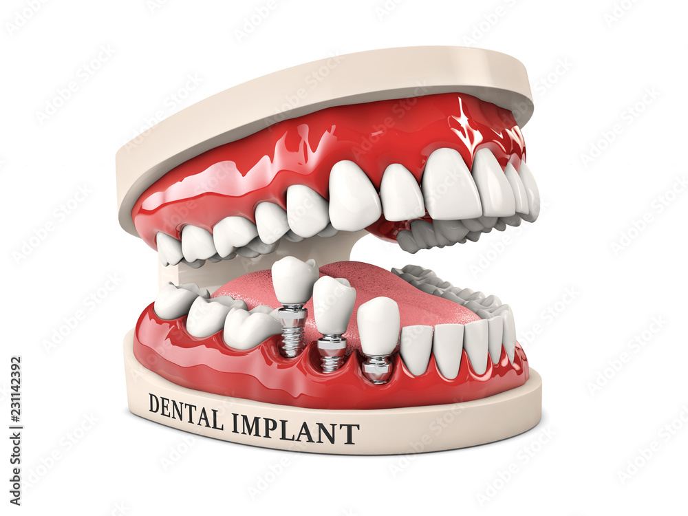 Human teeth and Dental implant. Stock 3d illustration. Human teeth and Dental implant. Stock 3d illustration.