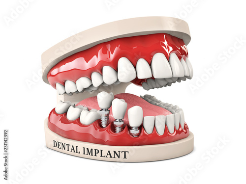 Human teeth and Dental implant. Stock 3d illustration.