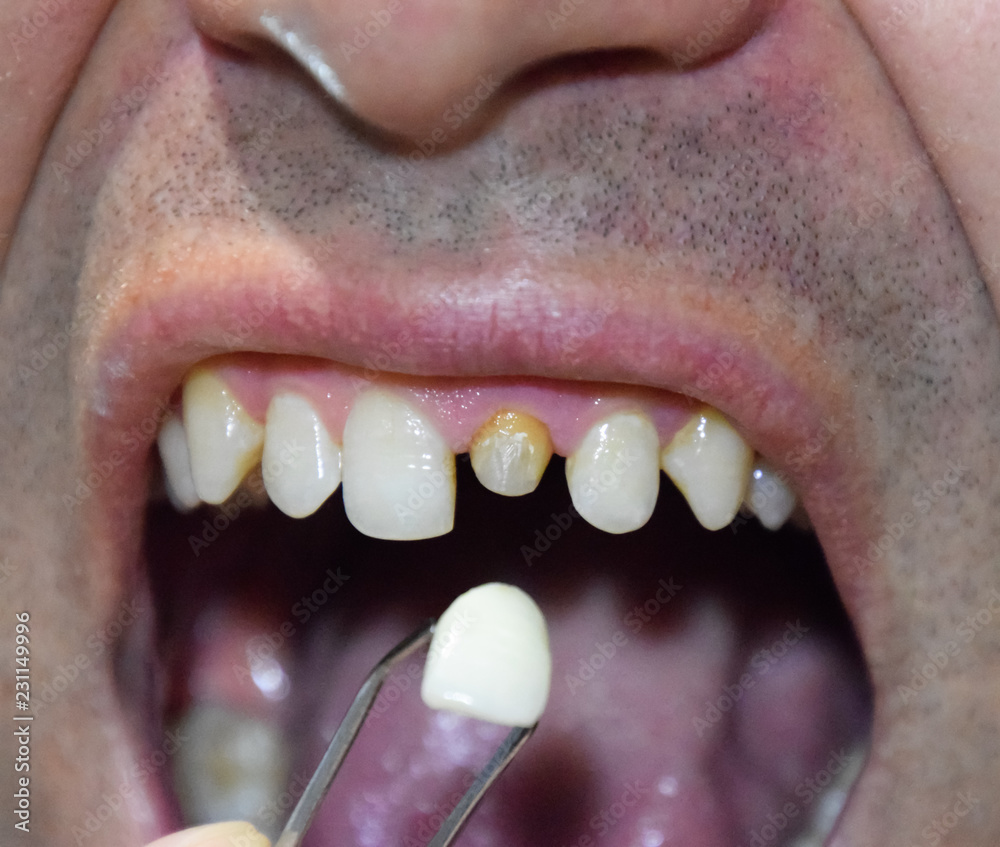 Fototapeta premium Dental prosthesis of metal ceramics in tweezers. A patient without a tooth is trying on a denture. Tooth implantation, dental treatment.