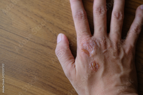 Psoriasis vulgaris, fungus, eczema on hand with pus. rash, dermatological problem on dry skin photo