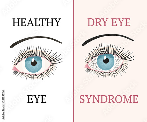 Eye disease. Ophthalmology health illustration.