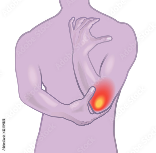 A medical illustration of the symptoms of elbow pain or tennis elbow, also known as epicondylitis.