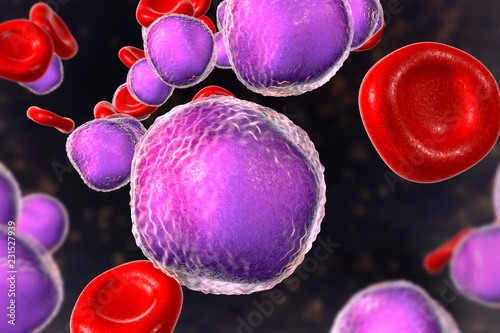Tablou pe pânză Acute lymphoblastic leukemia