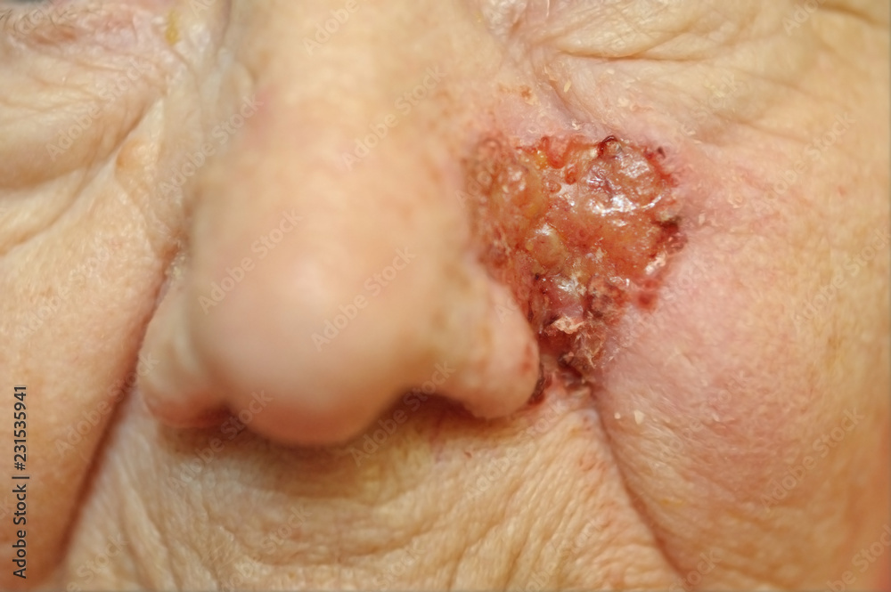 neoplasm on the skin neoplasm on the skin
