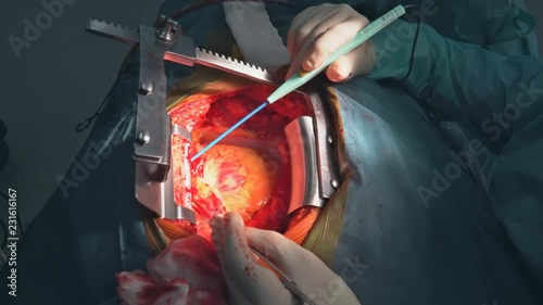 Heart surgery. Open heart surgery suture greater saphenous vein coronary artery bypass surgery photo