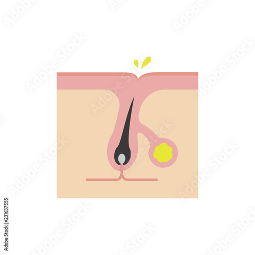 Cross section of pores ( acne progression) / Excessive secretion of sebum