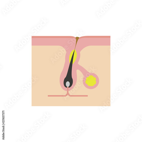 Cross section of pores ( acne progression) / Clogged pore