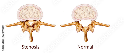 white background vector illustration of a Stenosis illustration photo