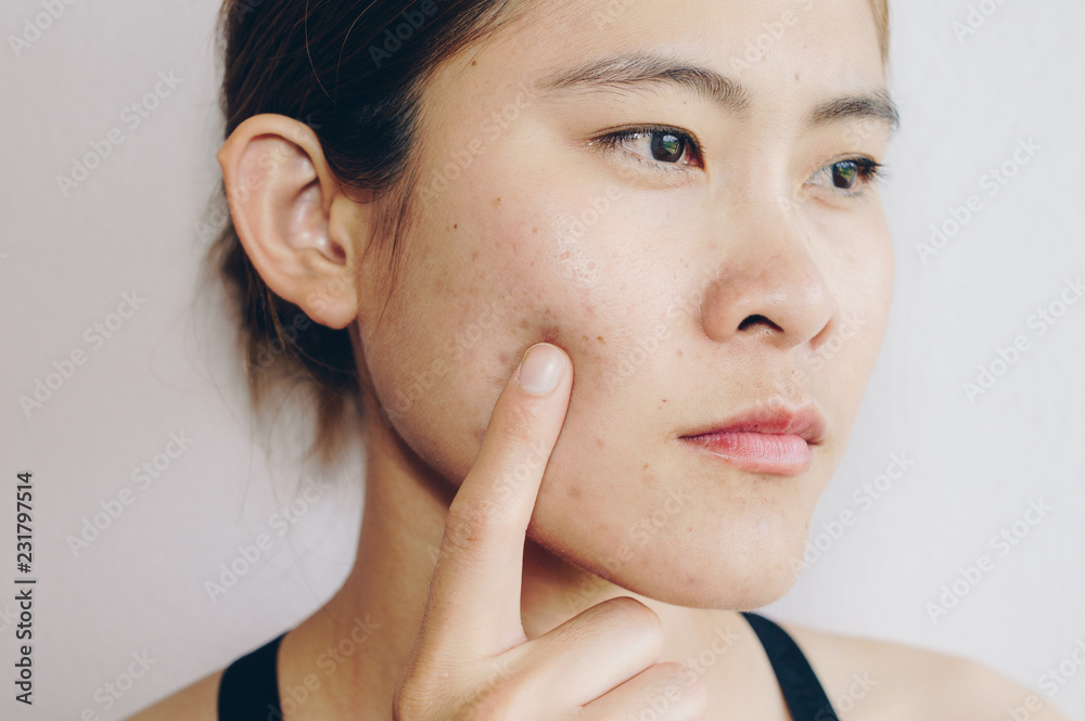 Asian woman has problems with skin on her face. Asian woman has problems with skin on her face.