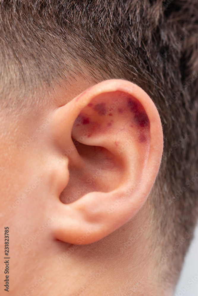 small bruises on the ear small bruises on the ear