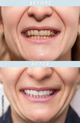 Woman teeth before and after dental treatment