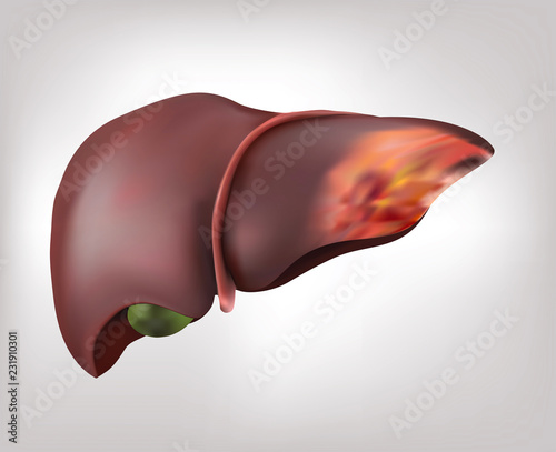 A realistic human liver image of a healthy human disease and cirrhosis.