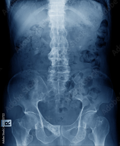 x-ray image of old man show ankylosing spondylitis or bamboo spine photo