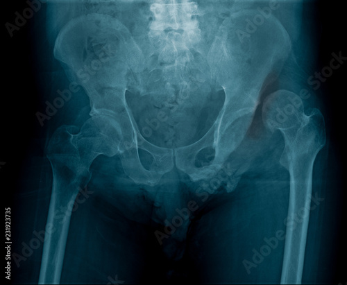dislocation of left hip joint