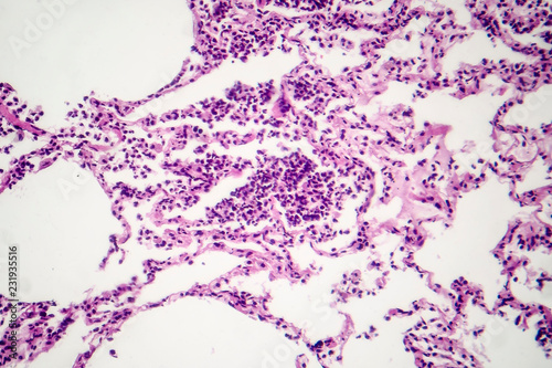 Histopathology of interstitial pneumonia photo