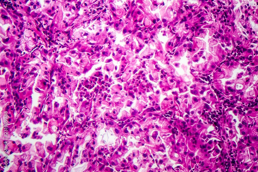 Histopathology of lung cancer Histopathology of lung cancer