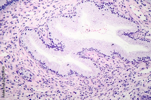 Histopathology of nasal polyps photo