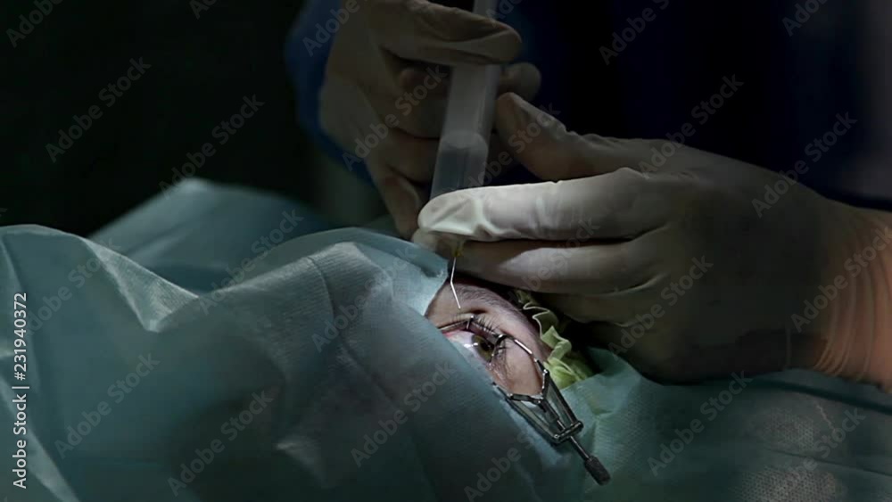 anesthesia before surgery laser vision correction, ophthalmology