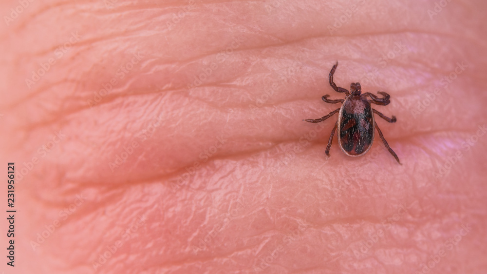 Brown dog tick parasite. Skin close-up. Rhipicephalus sanguineus. Ixodida. Infected mite on wrinkled human finger detail. Tick-borne diseases carrier. Canine babesiosis, ehrlichiosis, hepatozoonosis. Brown dog tick parasite. Skin close-up. Rhipicephalus sanguineus. Ixodida. Infected mite on wrinkled human finger detail. Tick-borne diseases carrier. Canine babesiosis, ehrlichiosis, hepatozoonosis.
