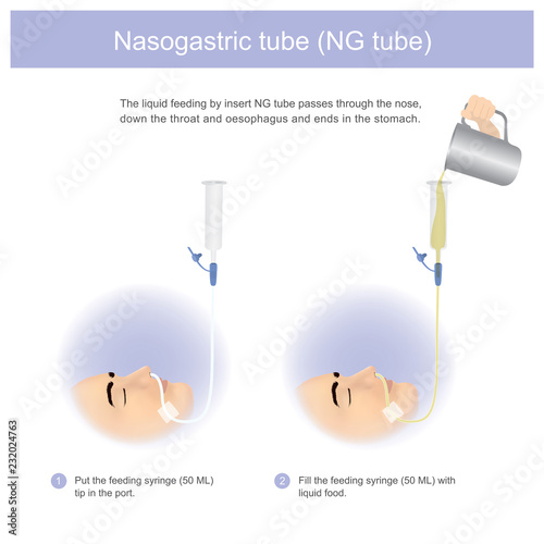 Nasogastric tube. The liquid feeding by insert NG tube passes through the nose