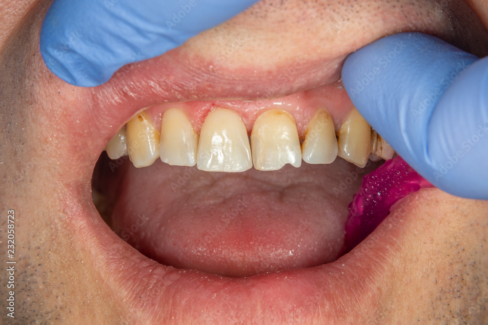 Obraz premium two chewing side teeth of the upper jaw after treatment of caries. Restoration of the chewing surface with a photopolymer filling material using the Rubber Dam system