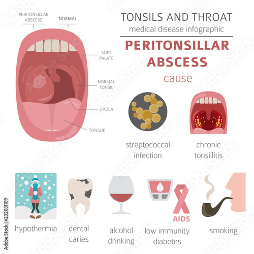 Tonsils and throat diseases. Peritonsillar abscess symptoms, treatment icon set. Medical infographic design