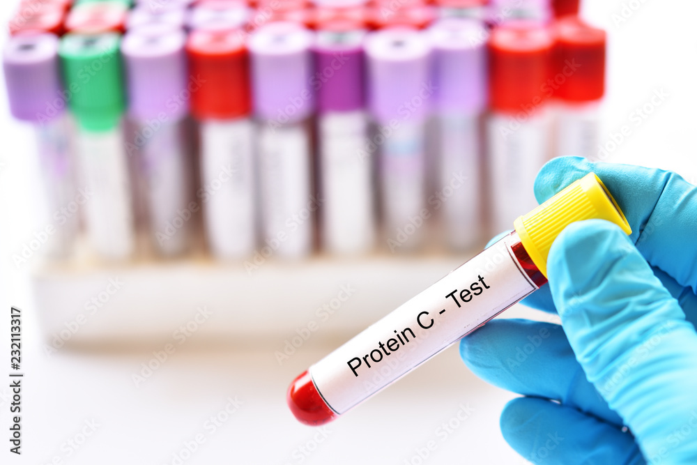 Obraz premium Test tube with blood sample for protein C test, coagulation disorder diagnosis