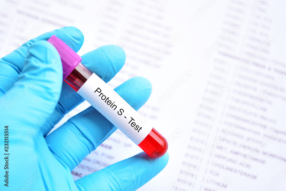 Obraz premium Test tube with blood sample for protein S test, coagulation disorder diagnosis