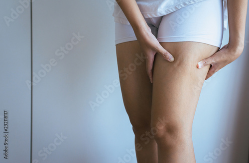 Woman with cellulitis on leg excess and overweight fatty of female photo