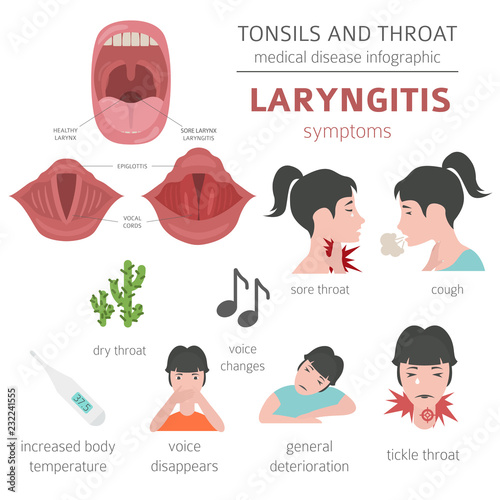 Tonsils and throat diseases. Laryngitis symptoms, treatment icon set. Medical infographic design