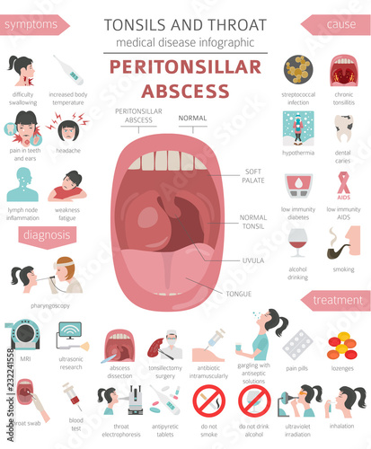 Tonsils and throat diseases. Peritonsillar abscess symptoms, treatment icon set. Medical infographic design
